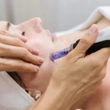 SkinPen Microneedling